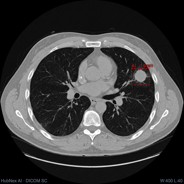 Chest CT scan with AI overlay